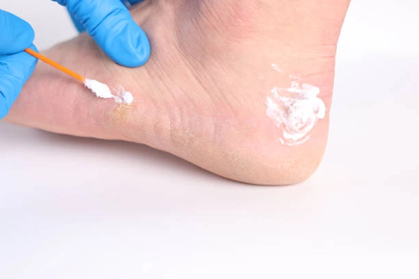 Calcanhar do pé rachado