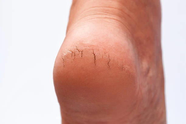 Limpeza de pé rachado em Niterói